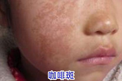 熊猫体育·(中国)官方网站小孩面部七种斑的图片(图2)