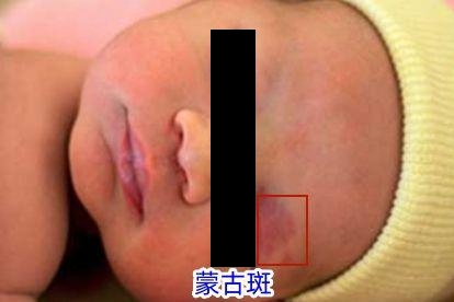 熊猫体育·(中国)官方网站小孩面部七种斑的图片(图3)