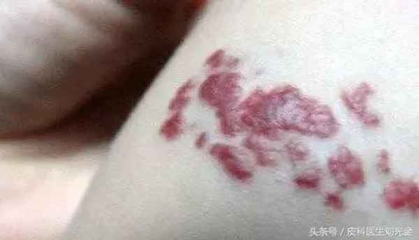 熊猫体育胎记激光好还是手术切除好;胎记激光效果(图1)
