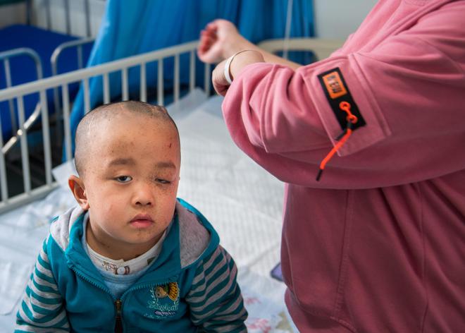 熊猫体育·(中国)官方网站男童经常摔跤开颅后发现脑袋里有特殊东西装上“抽水泵”保(图5)