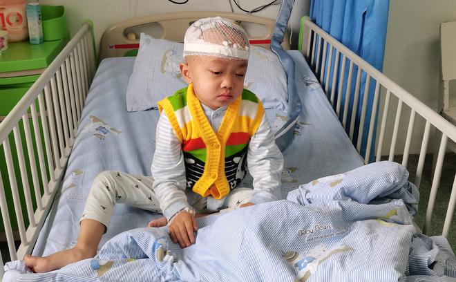 熊猫体育·(中国)官方网站男童经常摔跤开颅后发现脑袋里有特殊东西装上“抽水泵”保(图7)