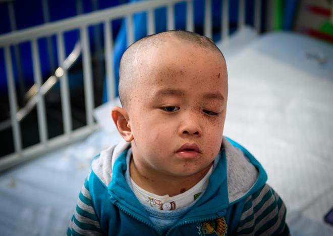 熊猫体育·(中国)官方网站男童经常摔跤开颅后发现脑袋里有特殊东西装上“抽水泵”保(图10)