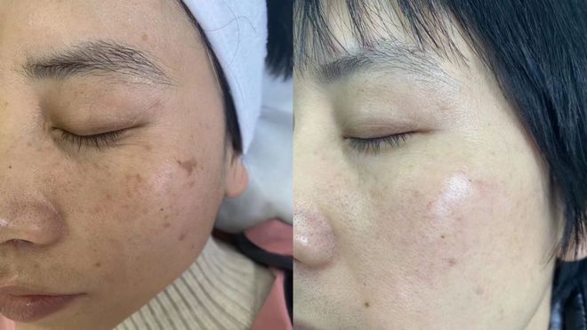 熊猫体育·(中国)官方网站远离百“斑”刁难南溪山医院祛斑美肤再添利器(图2)
