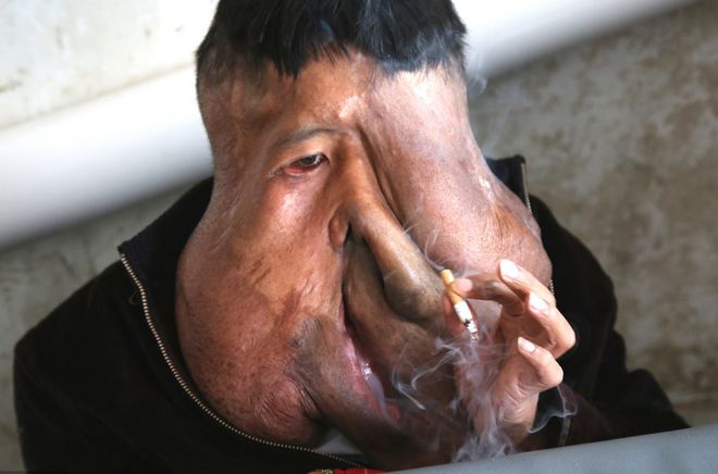 熊猫体育实拍“象面人”的生活日常脸部似怪物有人想买走卖票参观。(图1)