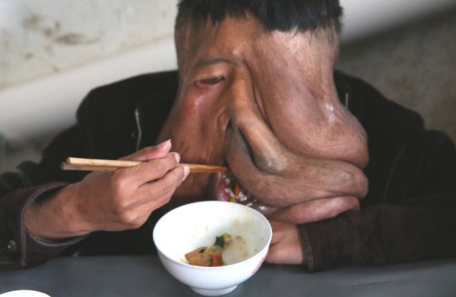 熊猫体育实拍“象面人”的生活日常脸部似怪物有人想买走卖票参观。(图3)